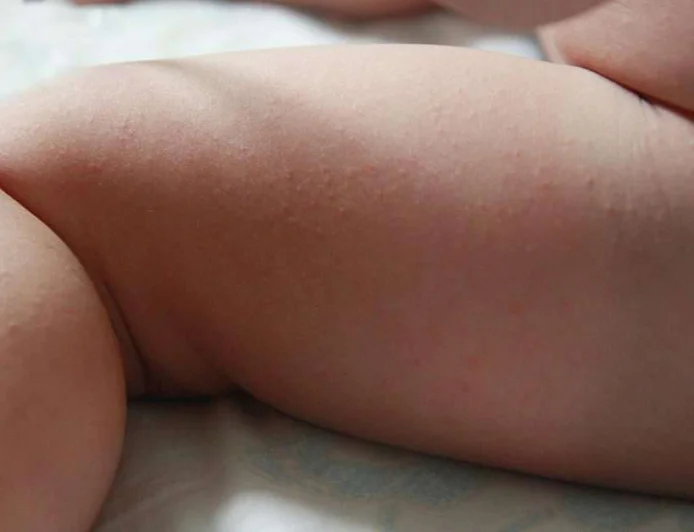 La sudamina nei bambini: cosa devi sapere e come affrontarla